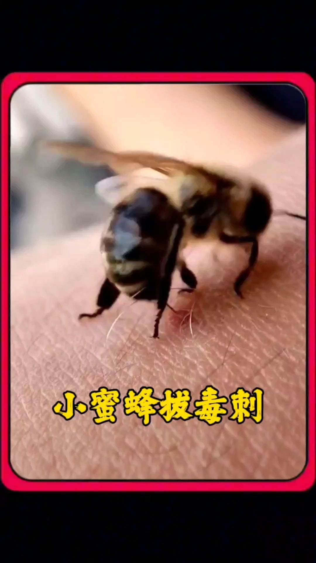 小蜜蜂拔毒刺