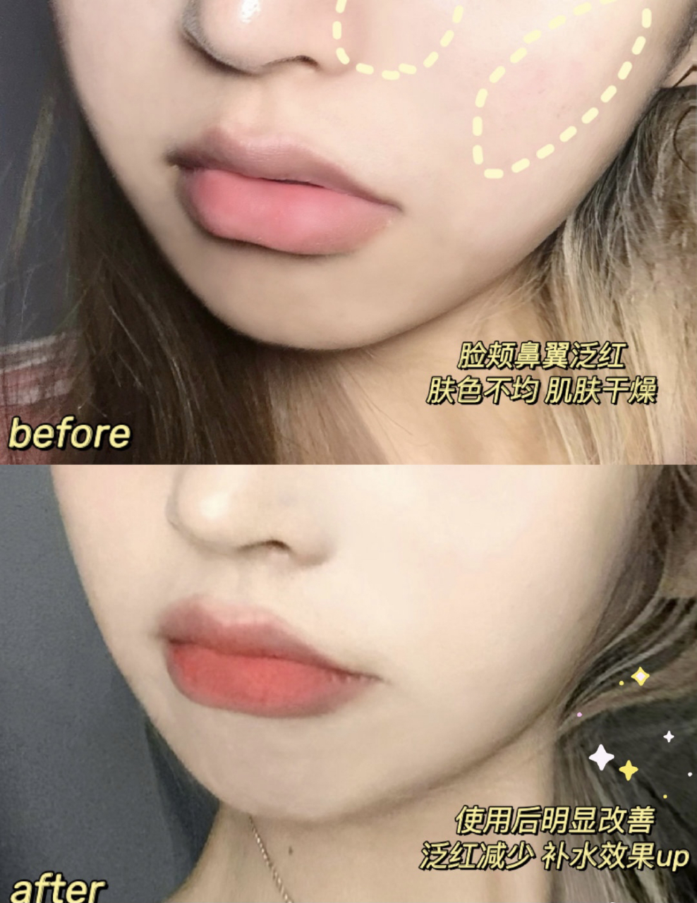 烂脸期间修护我会用春阳博士温和特护乳液～ 无添加无酒精 敏感肌