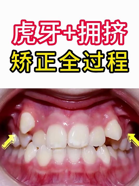 虎牙矫正视频全过程:1-12个月