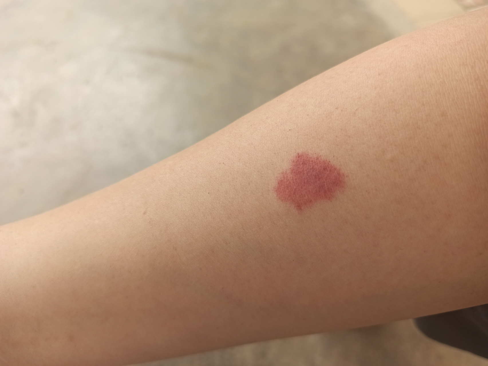 关于我手臂上这个红印,多年来记不清有多少人关心过,几乎都是这样问我