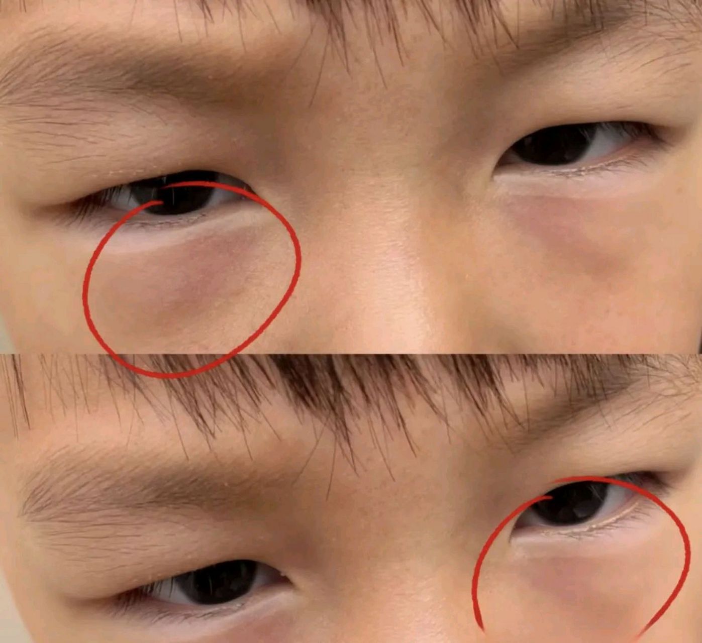 孩子下眼袋发青可能是脾胃不好的表现.