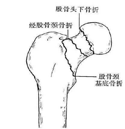 股骨颈骨折图片示意图图片