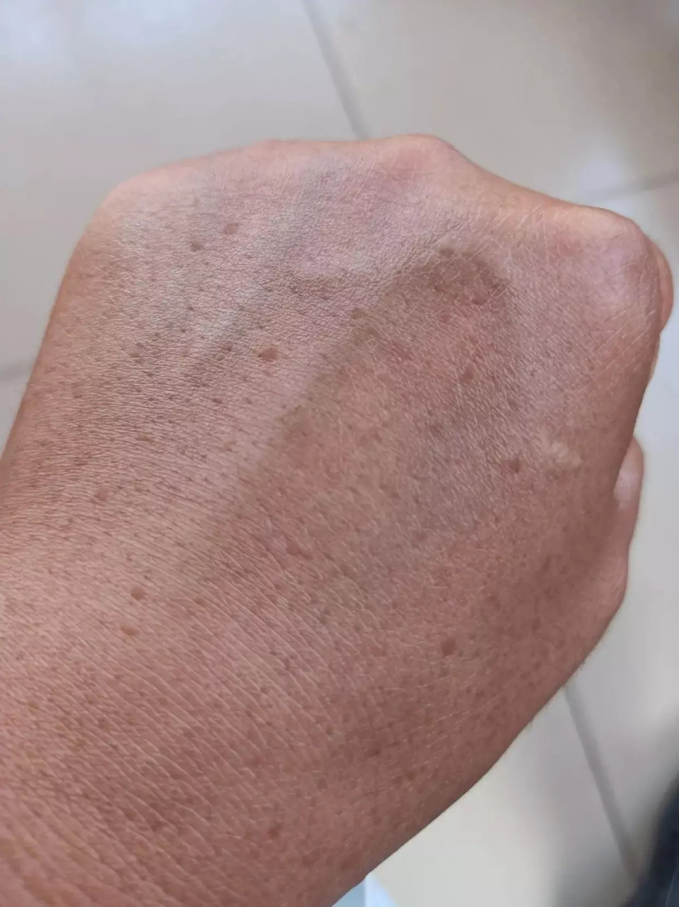 网友:我今年37岁,手上就有这么多老年斑,属于早衰吗?正常吗?[泪奔]