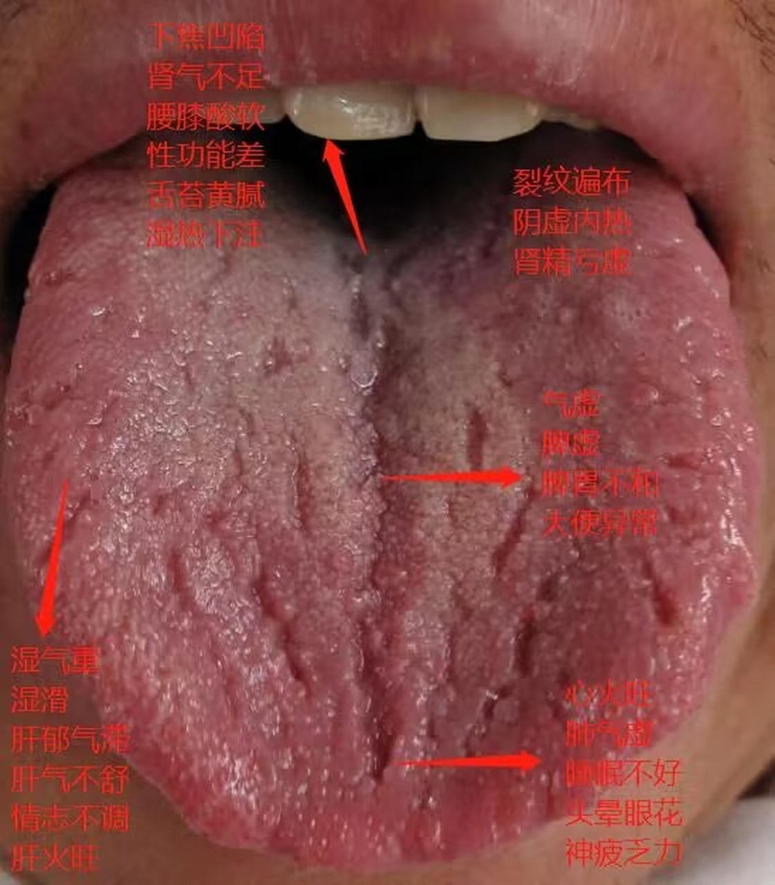 今日舌诊分析#健康养生# #肾虚# #舌诊