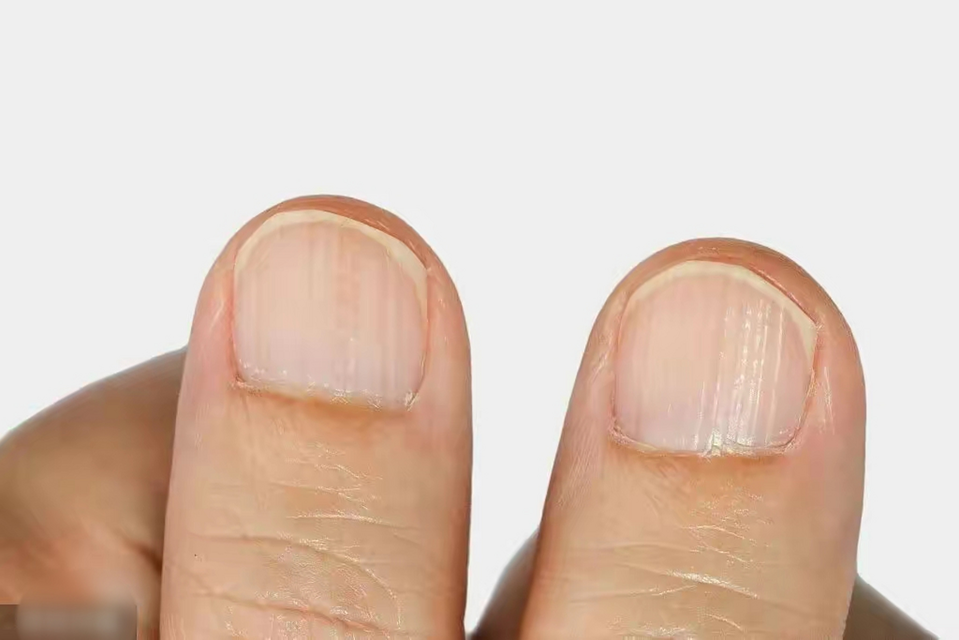 指甲有竖纹,就是不健康?  1.月牙越多身体越健康?月牙越少身体越差?