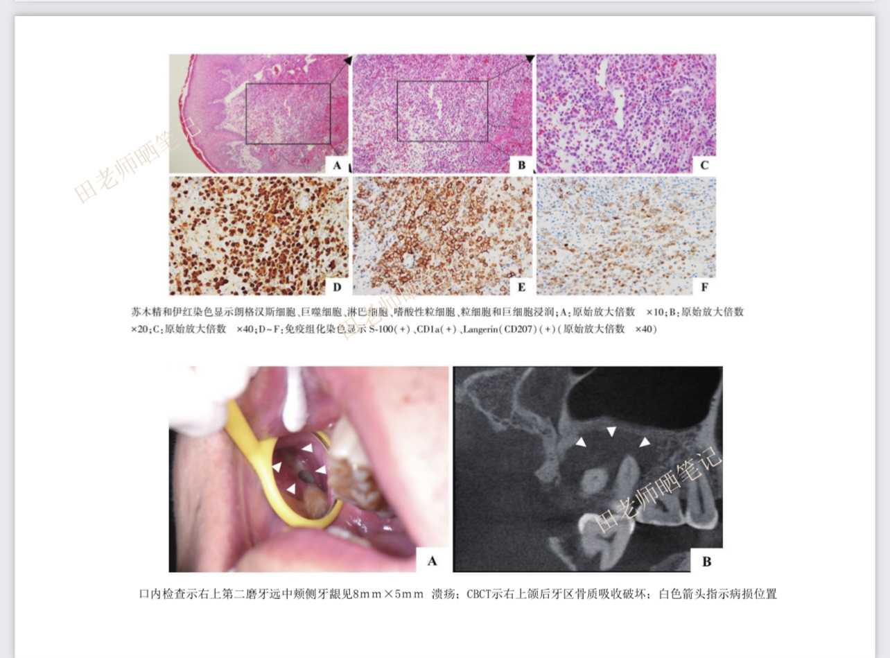 朗格汉斯细胞组织细胞增生症