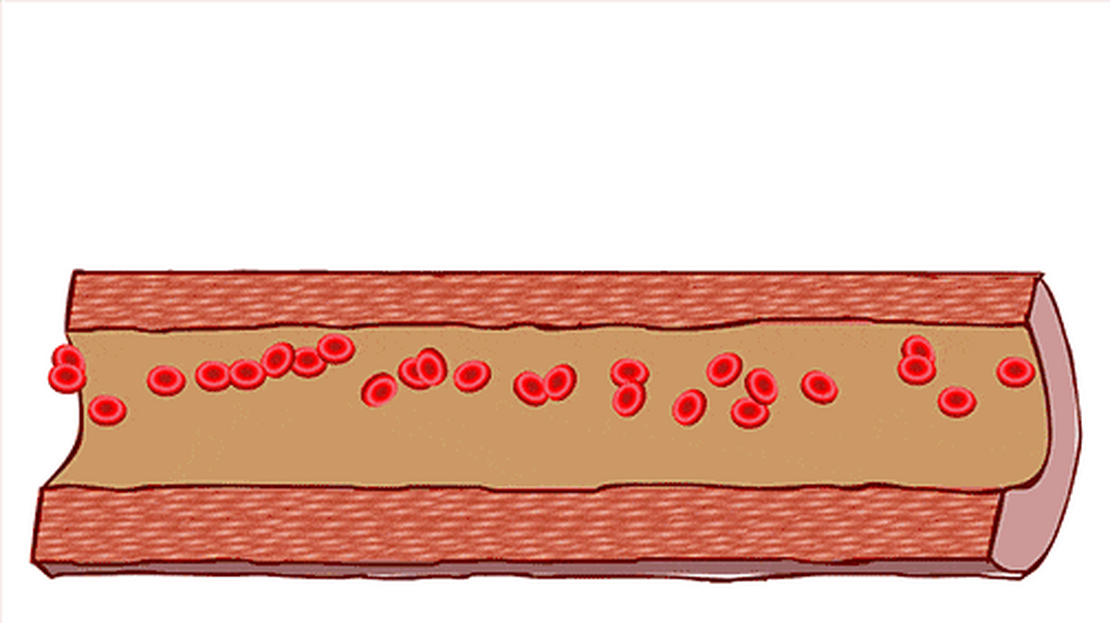 当微血栓大量长期积聚在体内,会阻塞毛细血管,影响血液流动和氧气交换