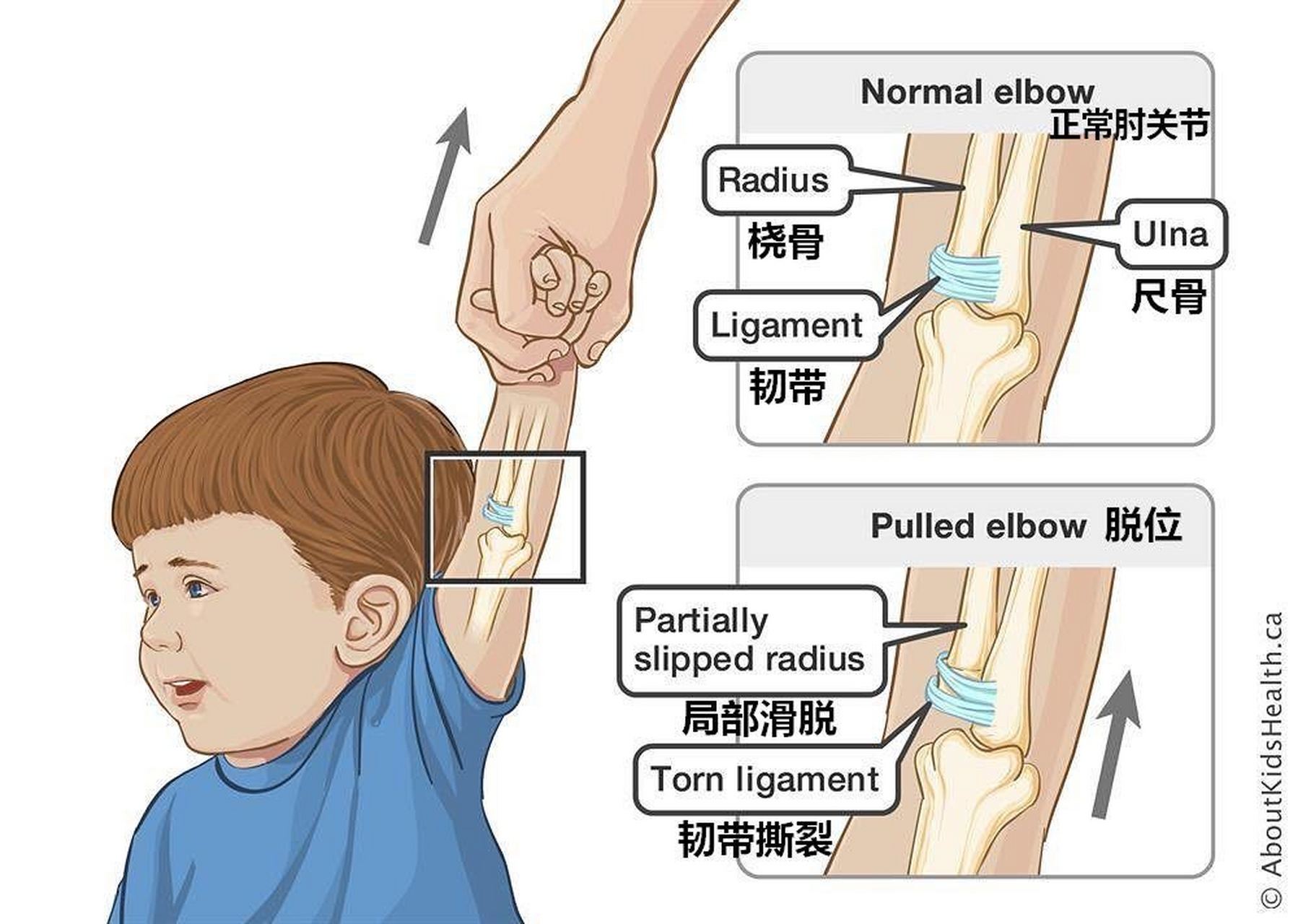 接诊桡骨小头半脱位患者应如何处置? a,拍x线片以确诊 b,急诊手术复