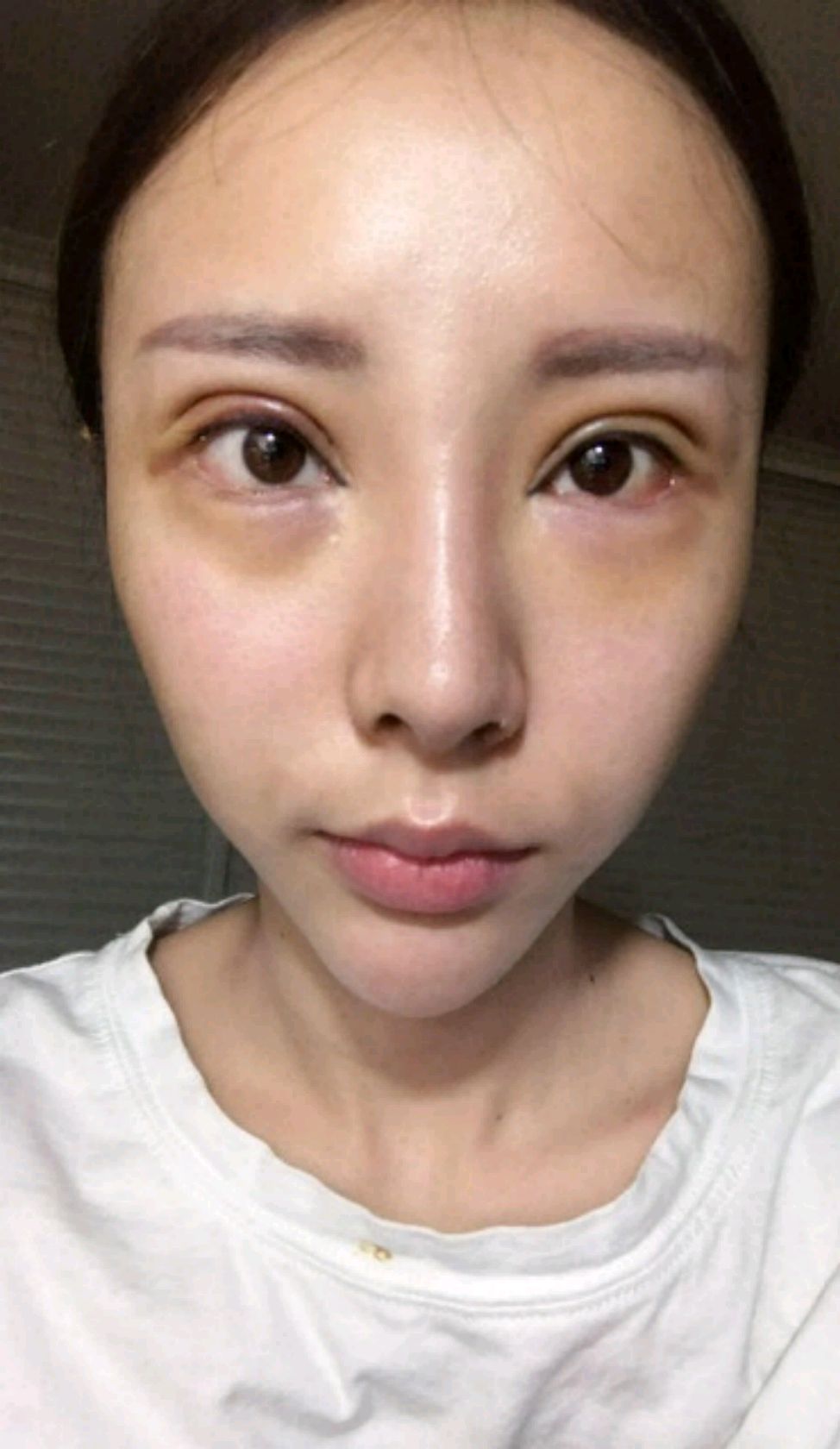 双眼皮手术以后容易出现水肿和出现淤青怎么办?