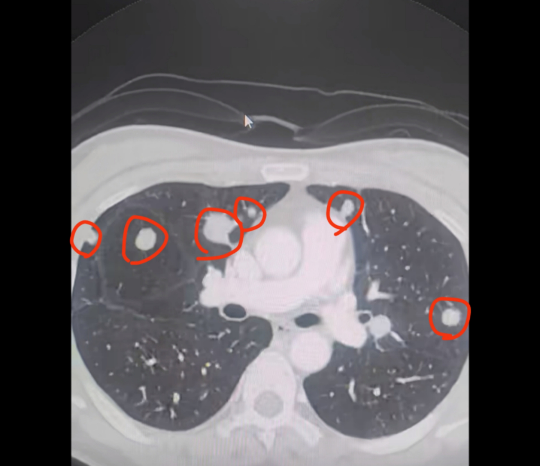 典型的肺转移瘤长什么样?