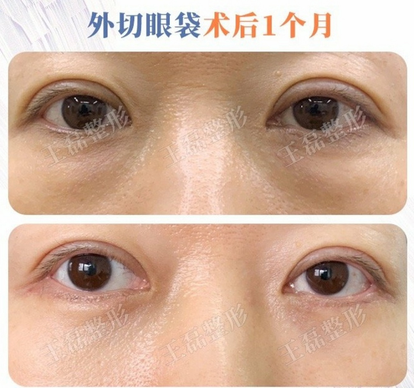 眼袋一旦出现靠护肤品是没有办法改善的,简单有效的方式就是通过手 