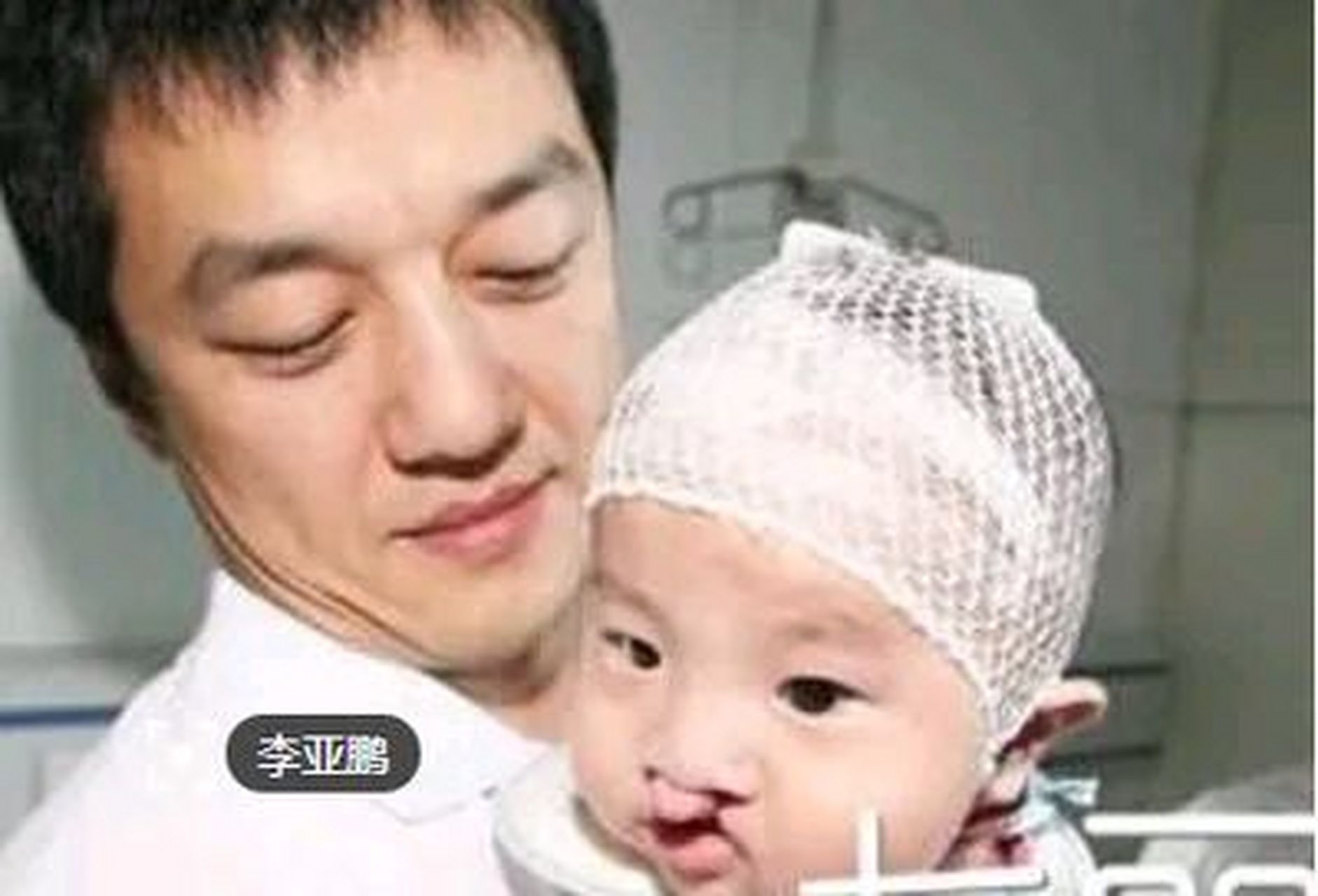 是的,王菲和李亚鹏的女儿李嫣患有先天性唇腭裂,也就是兔唇.