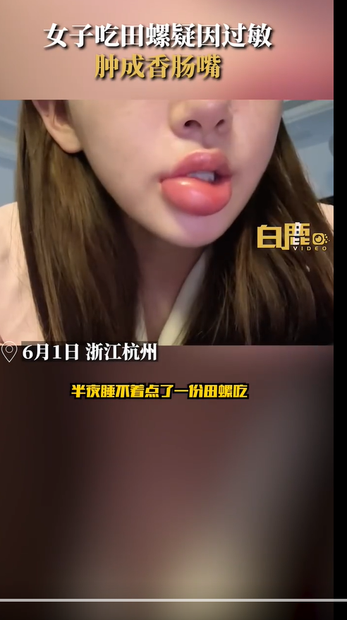 现实版东成西就?女子吃完田螺后嘴肿成香肠,引发食品过敏担忧
