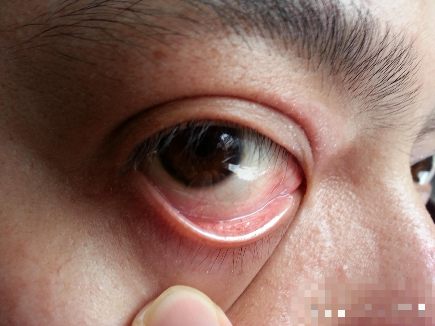 1.16 有结膜炎症状 xbb.1.