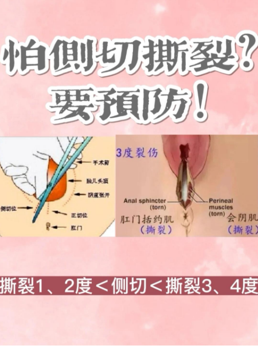 怕侧切撕裂?要预防!