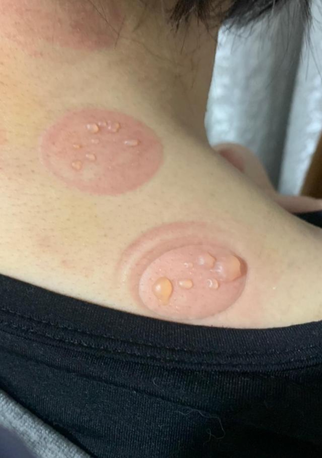 拔罐后出现水泡,别不当回事!正确处理水泡的办法在这里