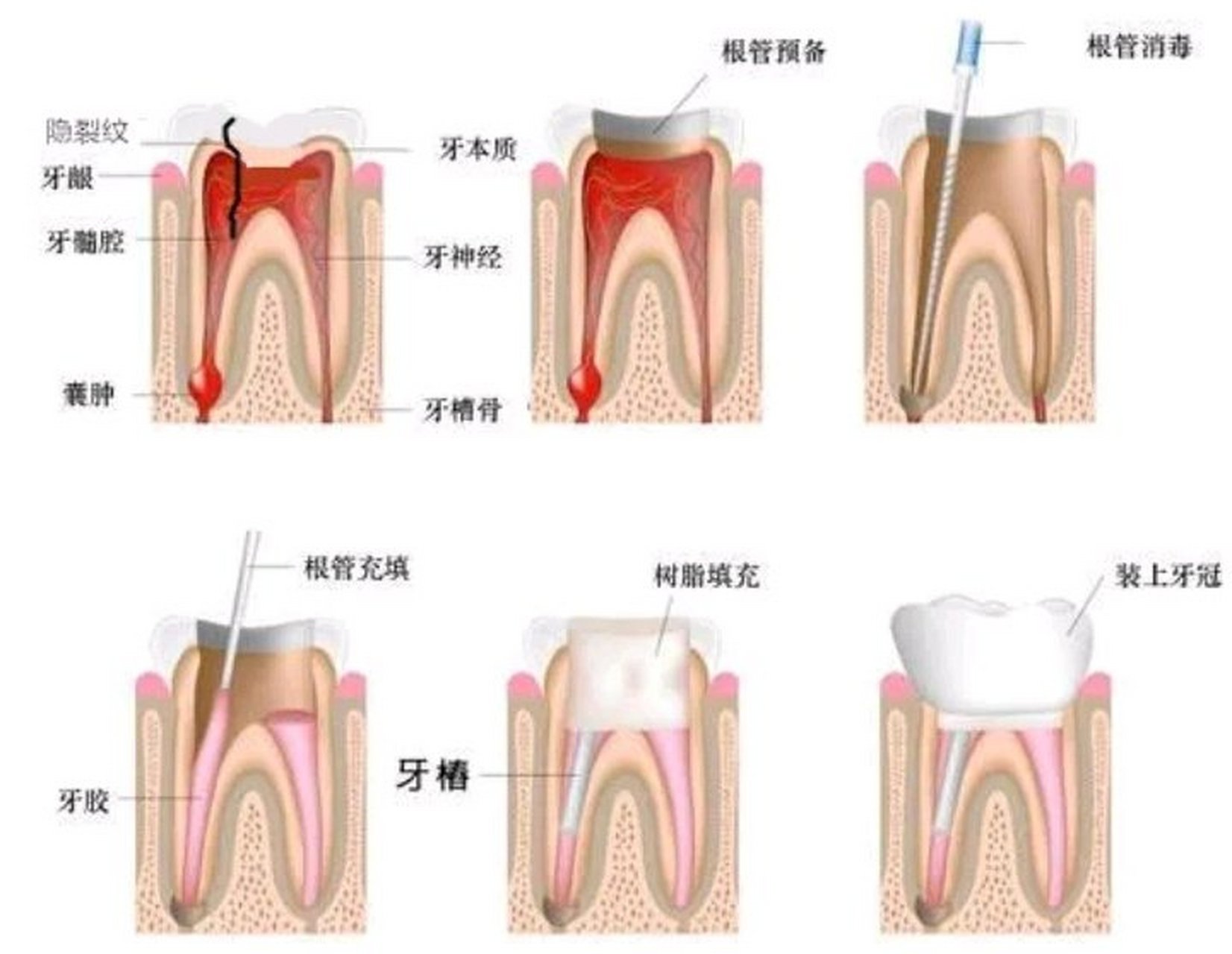 根尖周炎的治疗方法图片