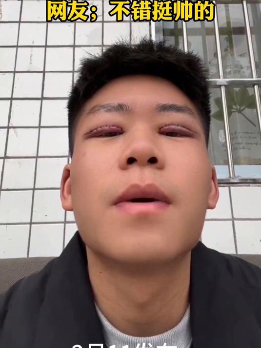男生晒自己割双眼皮的变化网友;不错挺帅的