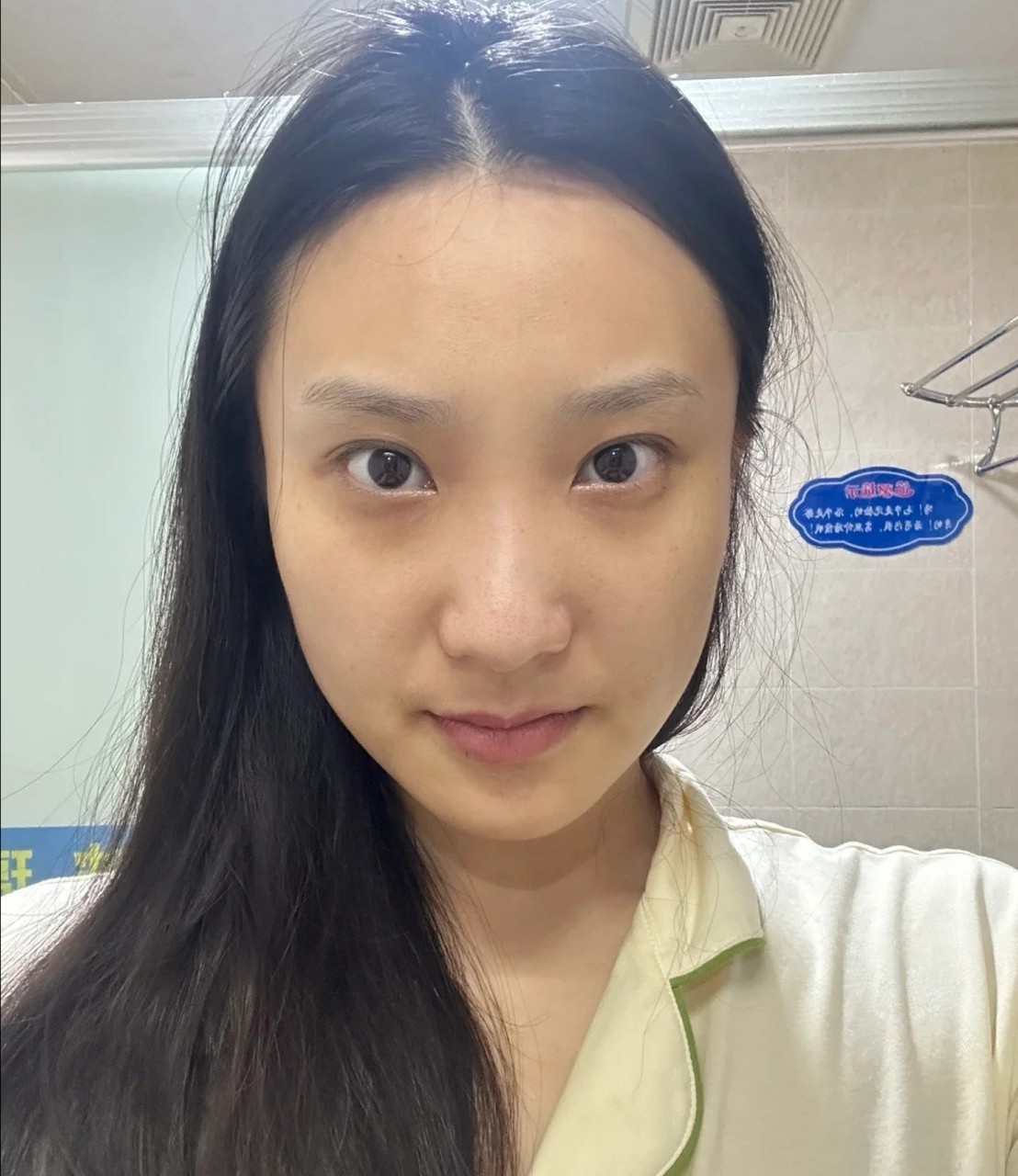 甲亢好了,突眼,粗脖子不见了!