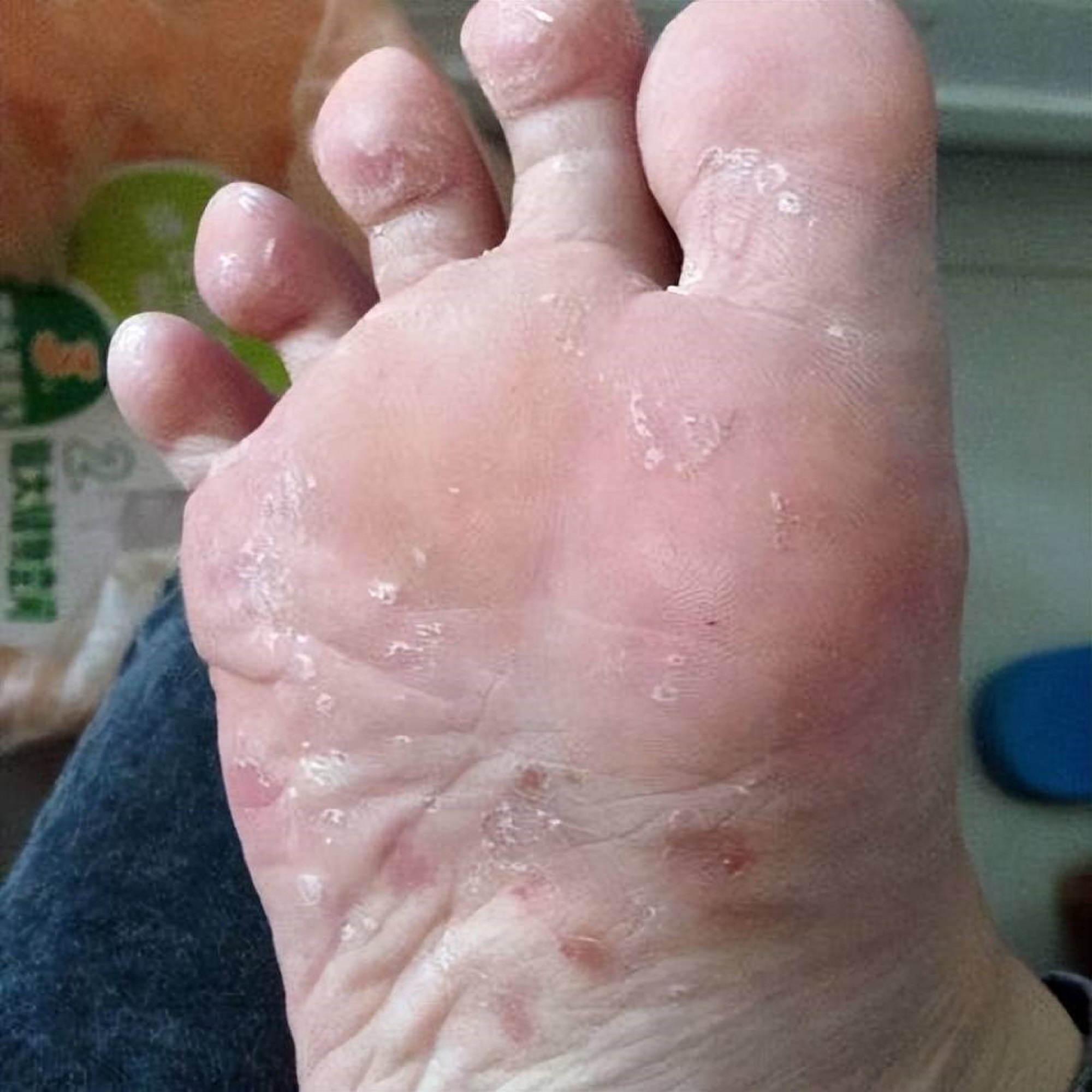 帮你轻松摆脱脚气烦恼!