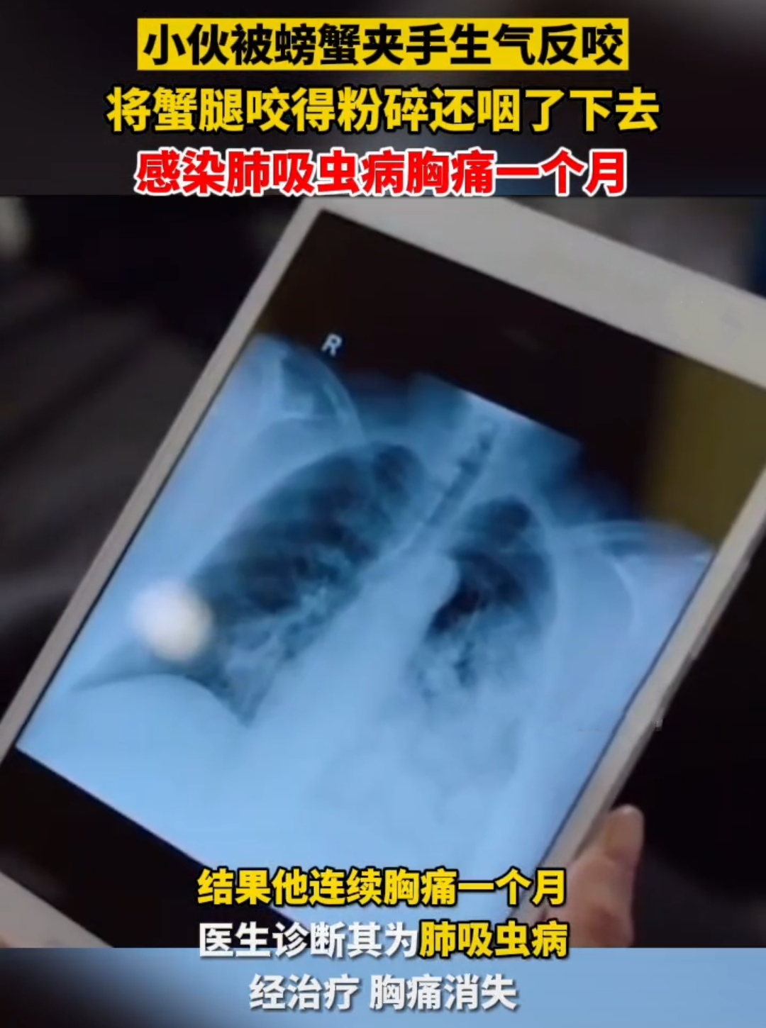 湖北十堰:小伙被螃蟹夹手生气反咬感染肺吸虫病,蟹腿还嚼得粉碎