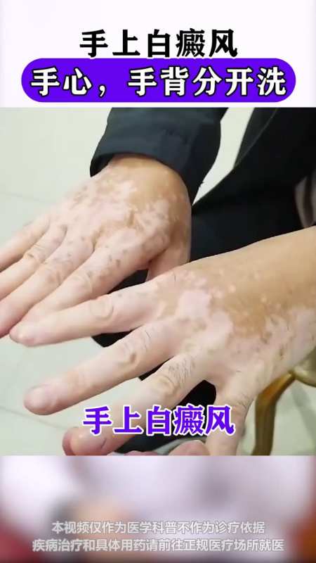 手上的白癜风手心手背分开洗