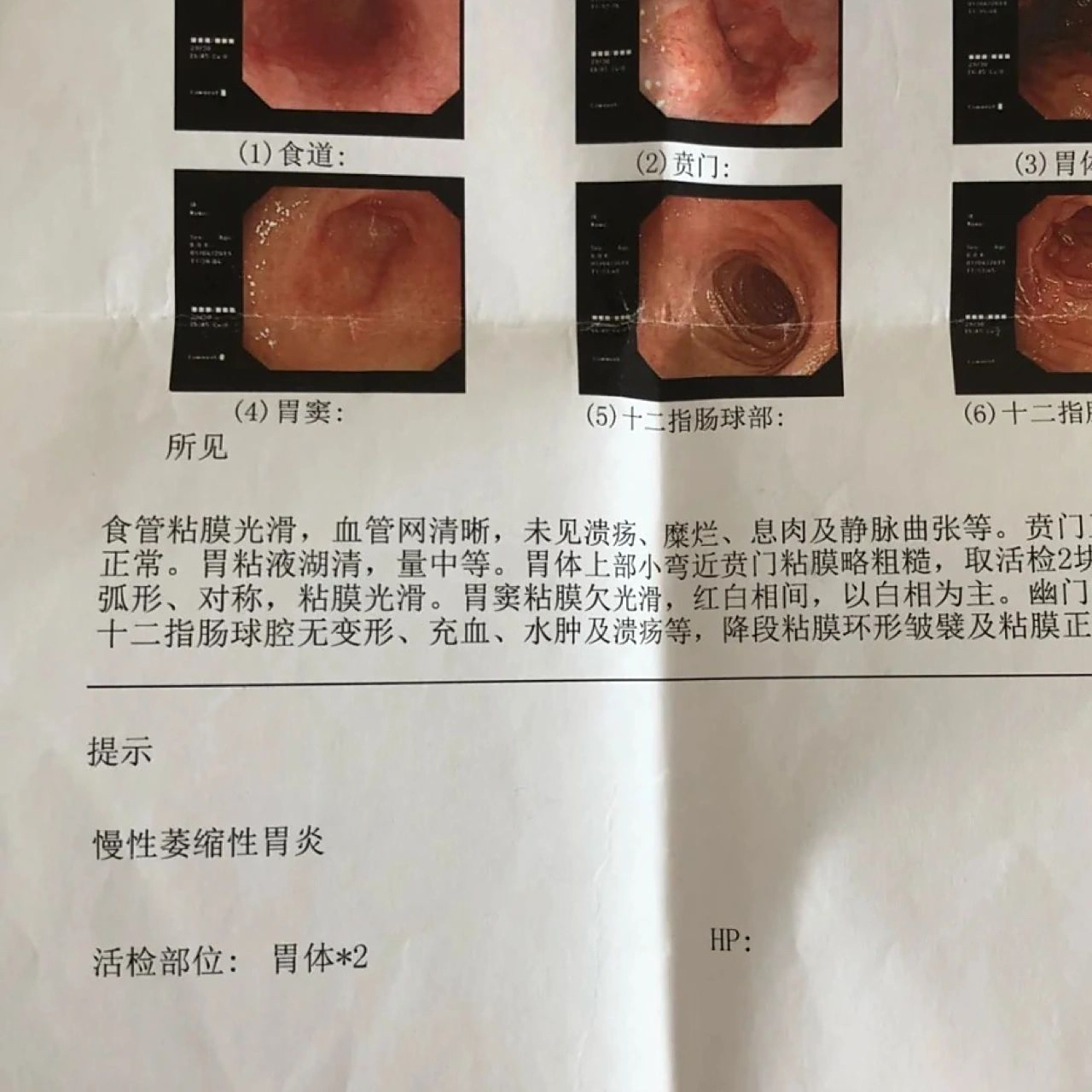 萎缩性胃炎是一种慢性消化系统疾病,其特征是胃黏膜上皮和腺体的退化