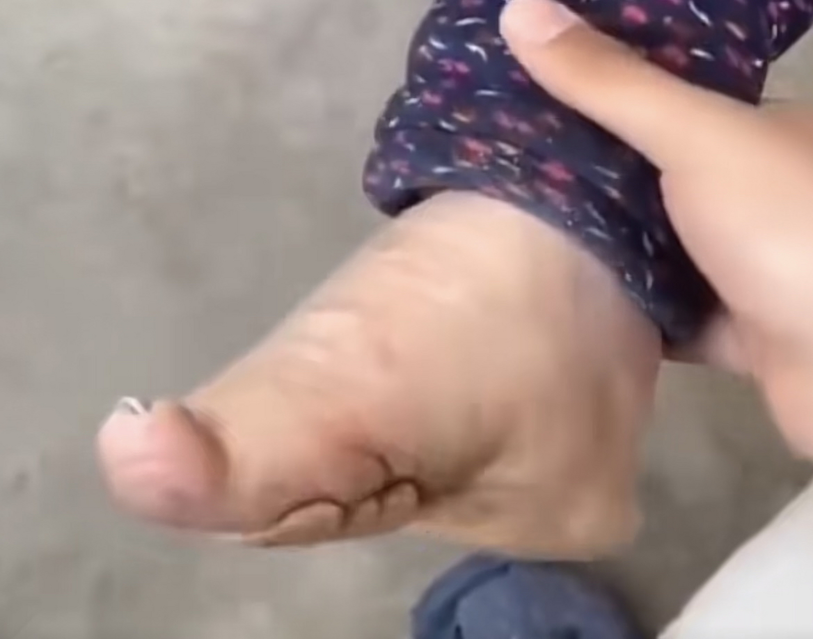 一女子晒出村里老奶奶的"三寸金莲",脚趾被折断压在脚掌下形成"高跟鞋