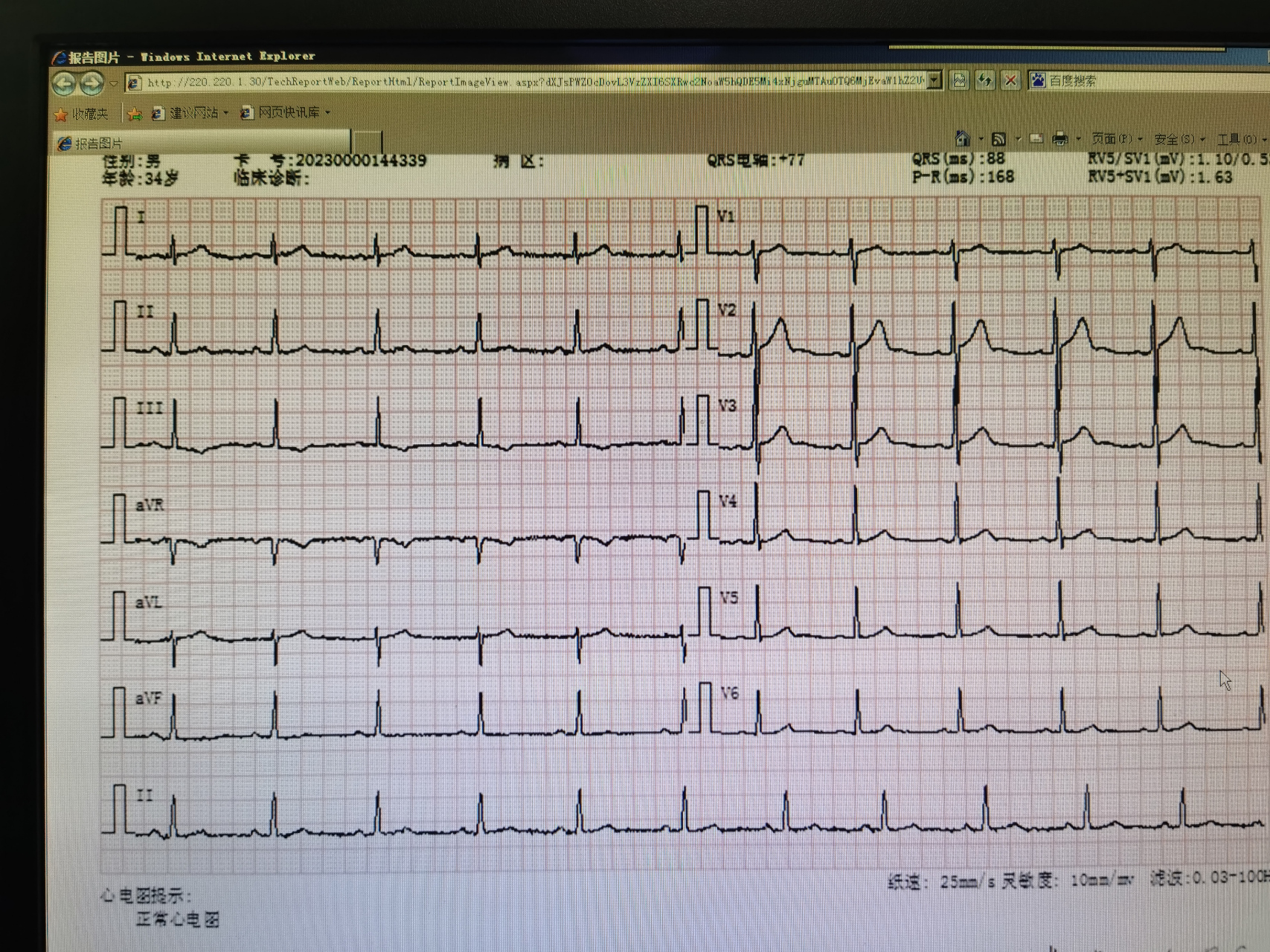 b型预激综合征消融术后复查,患者心电图恢复正常.