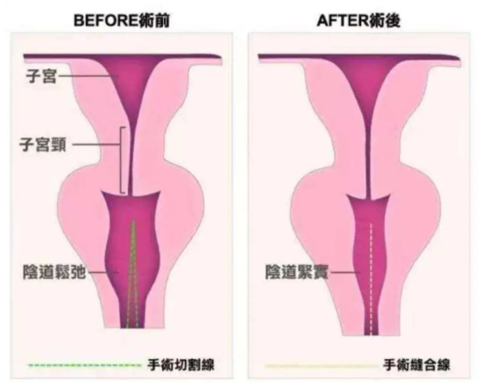 3d生物束带和普通紧缩手术区别在手术创伤,维持时间,价格不一样