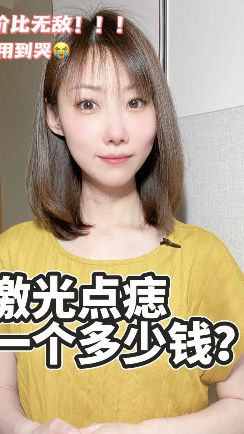 激光点痣一个多少钱?