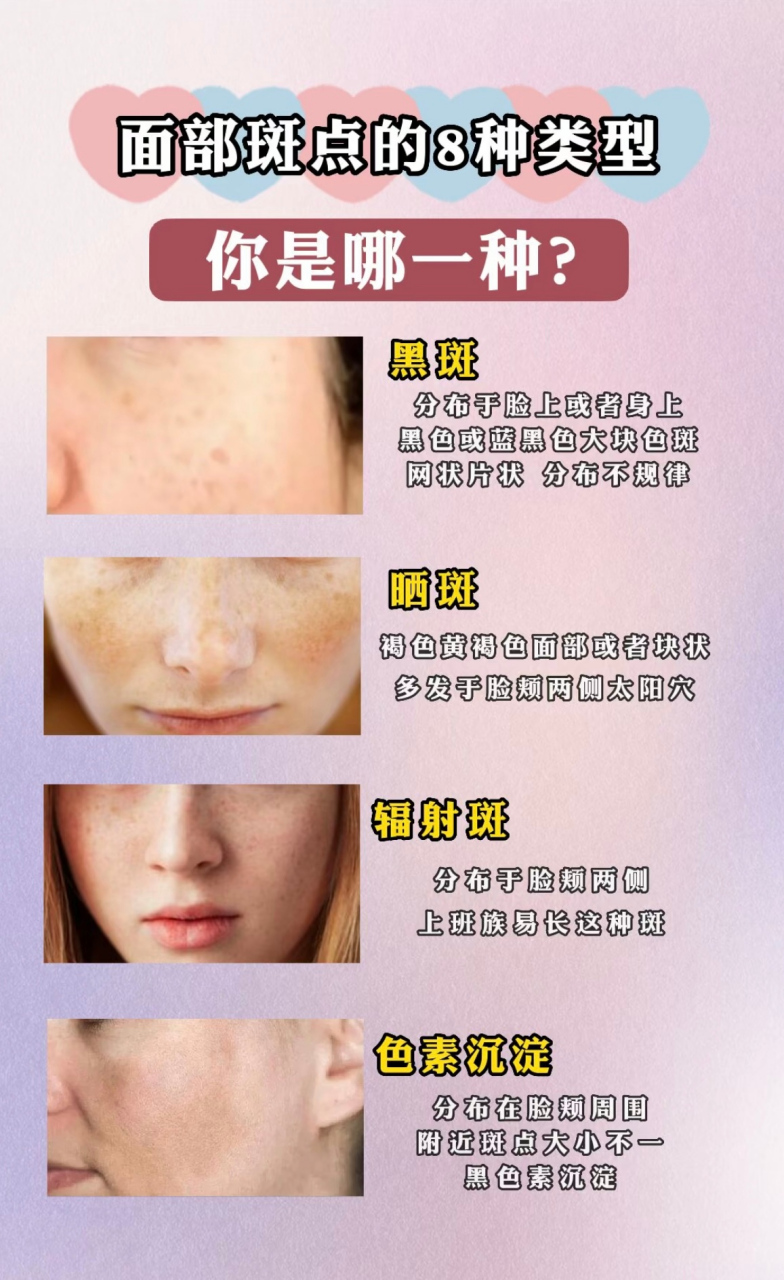 面部斑点的8种类型,你是哪一种? [心]雀斑: 针尖至米粒大小的棕色小斑