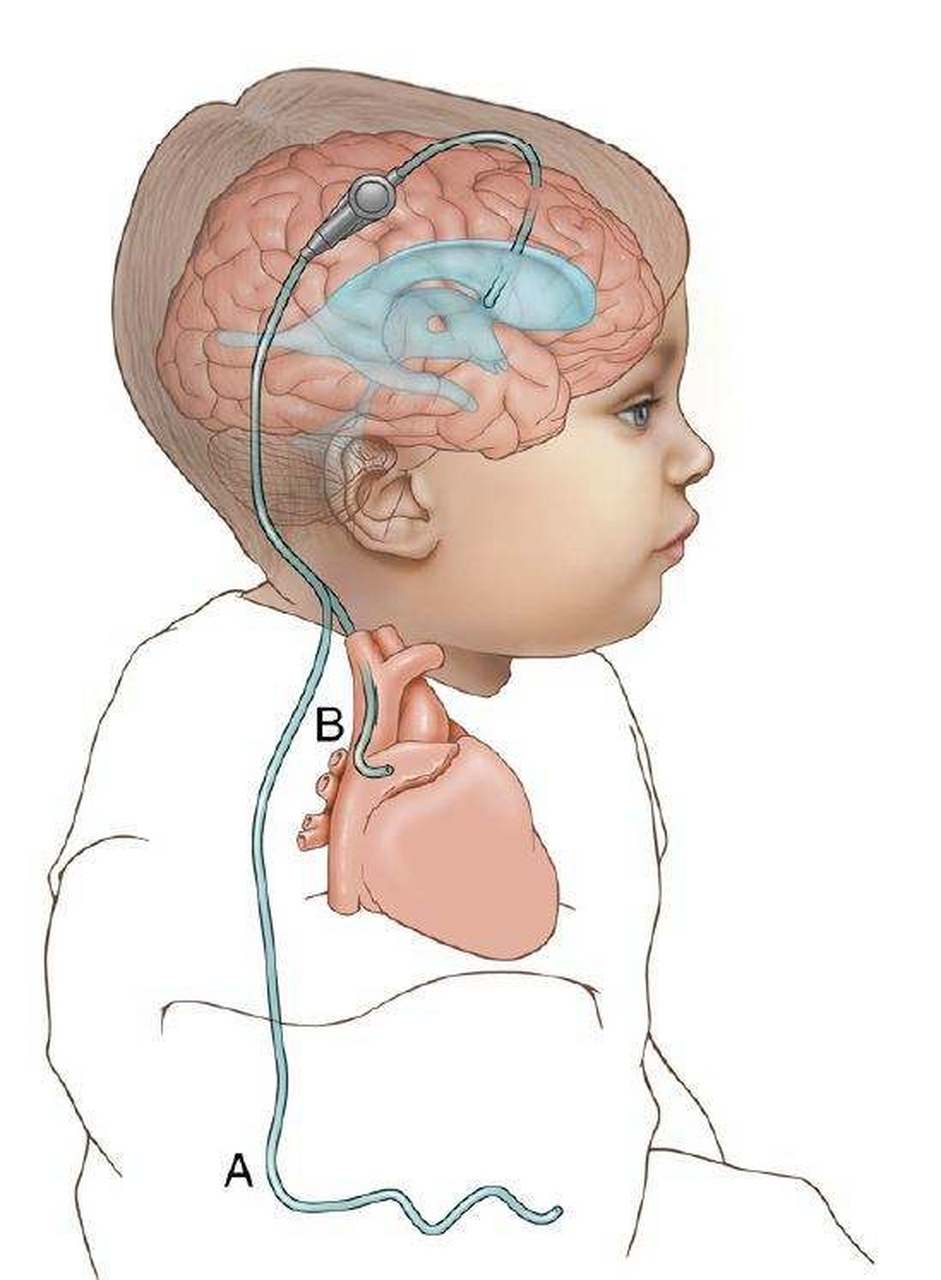 脑积水的分流管子是否需要终身携带?