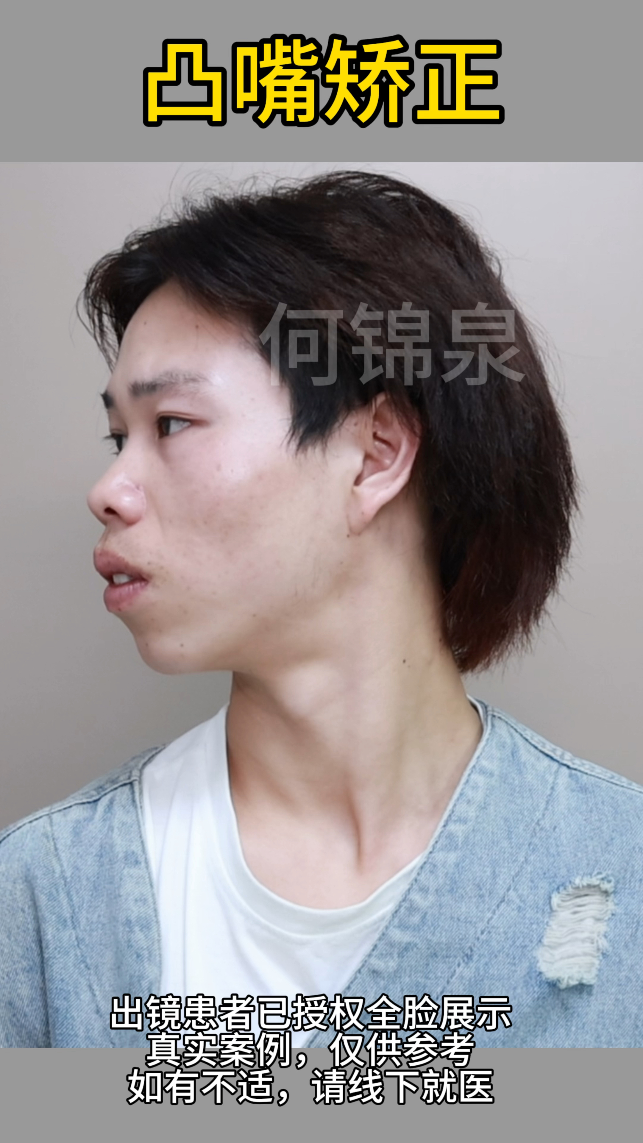 23岁男生凸嘴,下巴后缩矫正,正颌后第3天的对比