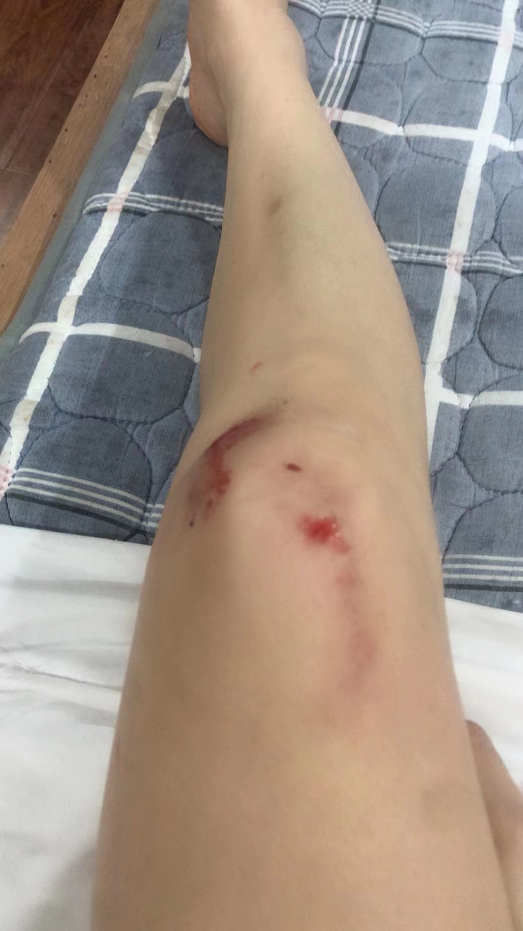 人生有时候就像这条腿,本来挺美的腿,被磕碰一下,出血又留疤,虽不算