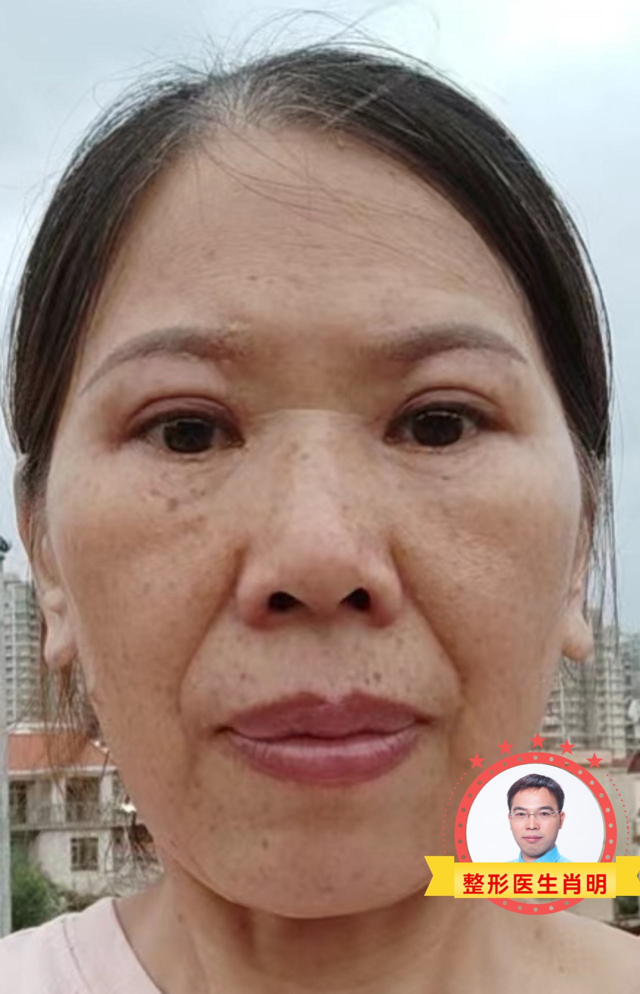 眼周年轻术语,熬得过风雨,终见彩虹!