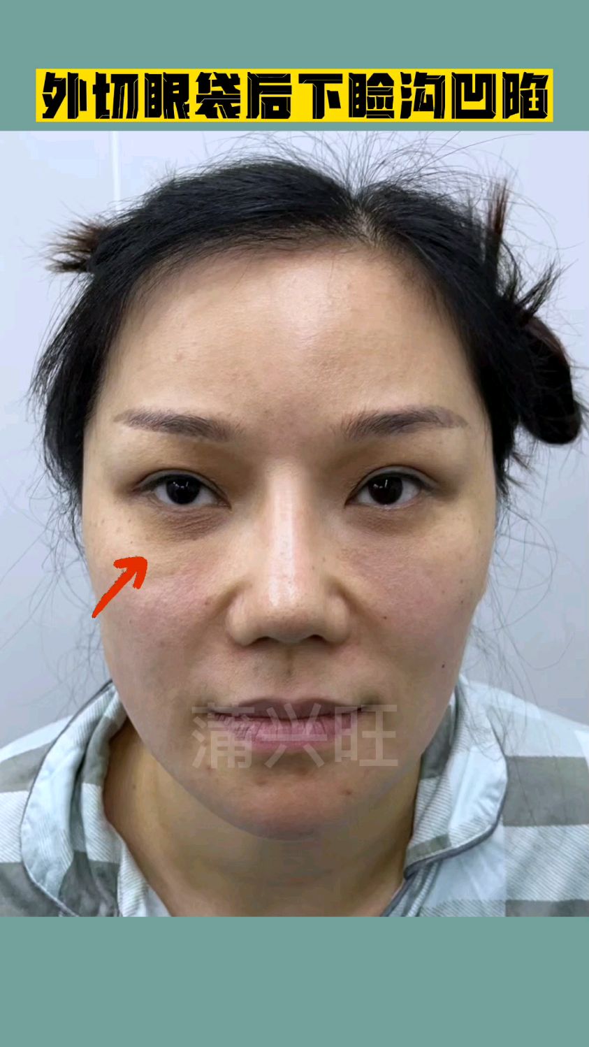 外切眼袋后下睑沟凹陷,同时苹果肌下垂法令纹明显,睑下口中面部小拉皮