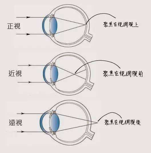 对于近视的了解,近视,远视,散光,老花眼