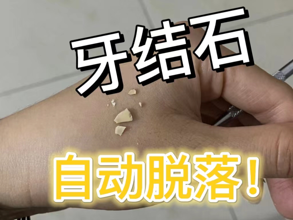 可能是牙结石在作怪!3个方法教你去除!