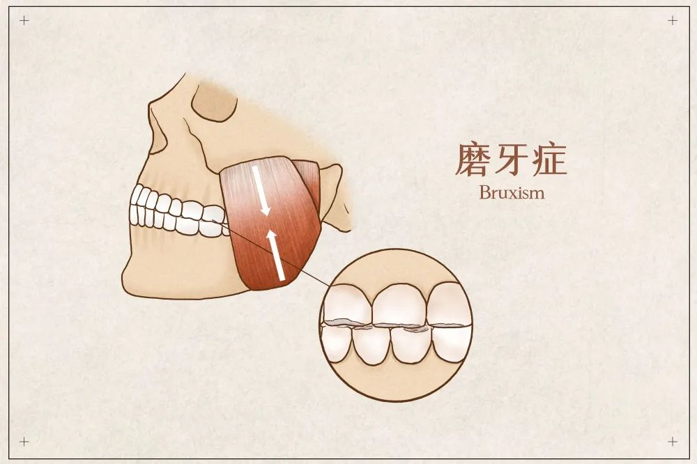 磨牙齒有什麼方法可以治