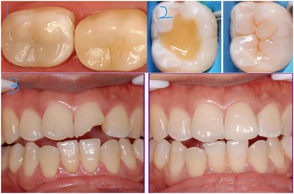 流體樹脂和固體樹脂補牙哪個好?補完牙多久可以正常吃東西呢?