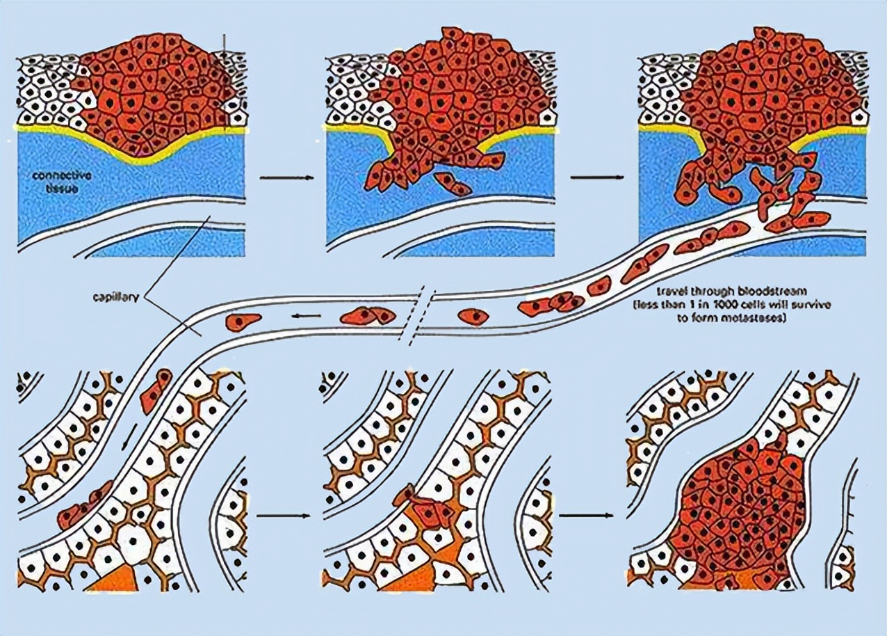 癌症转移不等于死亡,肿瘤扩散不要怕,现代医学治疗或许还有转机