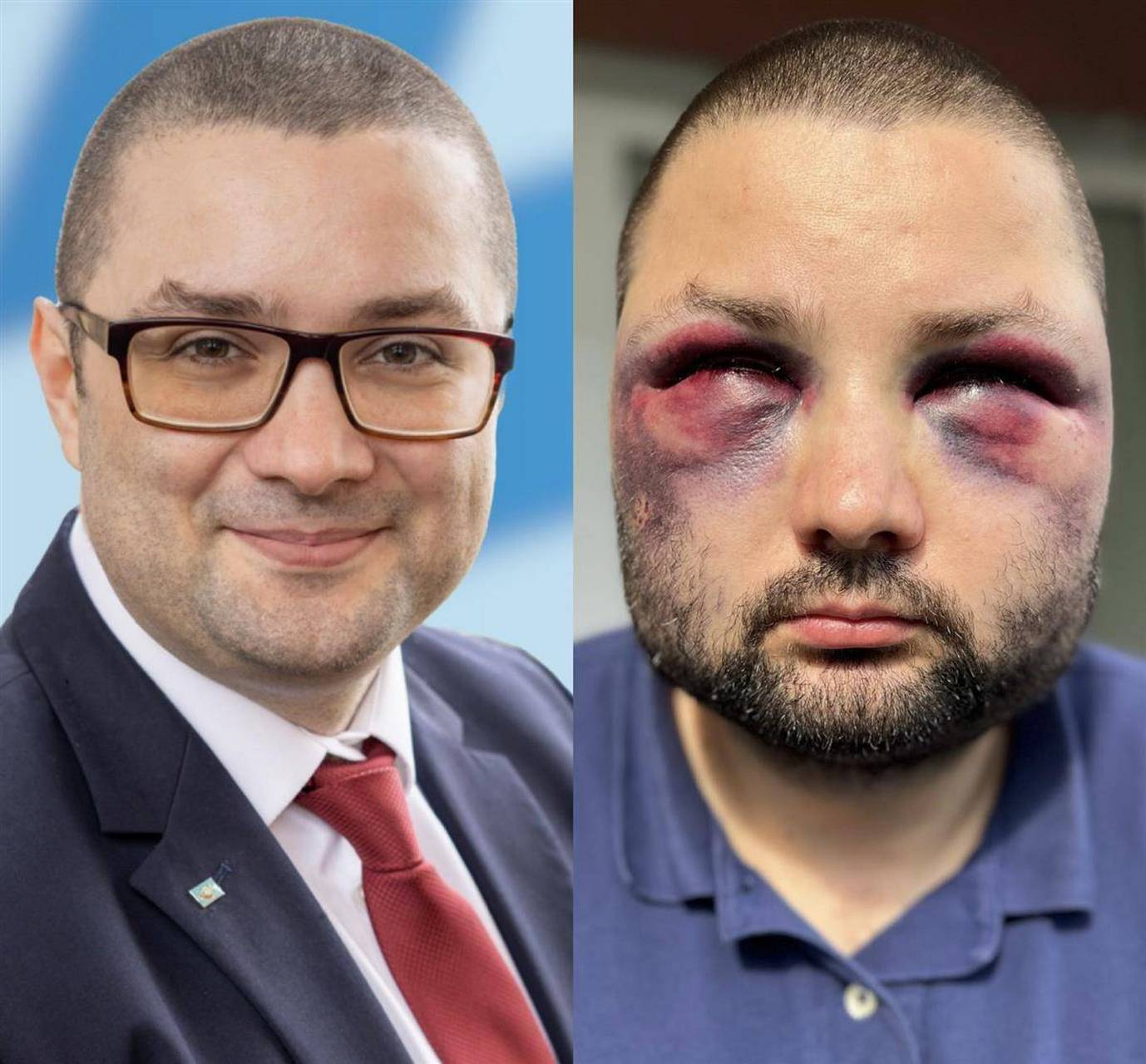 德国一政客回家途中遇袭,被打到鼻青脸肿成"熊猫眼",该政党以反移民立