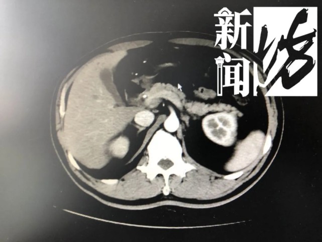 热点|上海一男子减肥，2个月轻了近20斤！正高兴，结果被查出两种癌