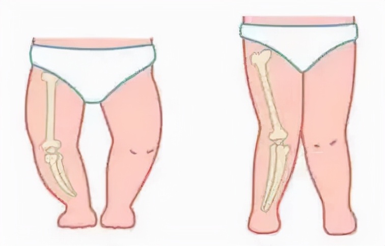 别再把孩子o型,x型腿的锅甩给太早站立了