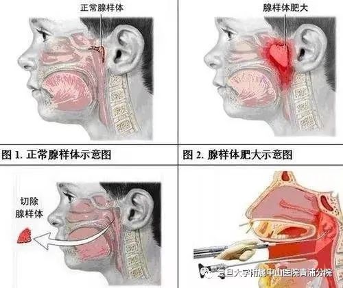 关于儿童腺样体肥大,这些知识家长需掌握