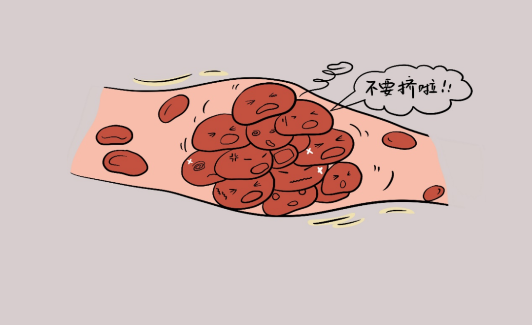 静脉血栓栓塞症——你所不了解的隐形杀手!