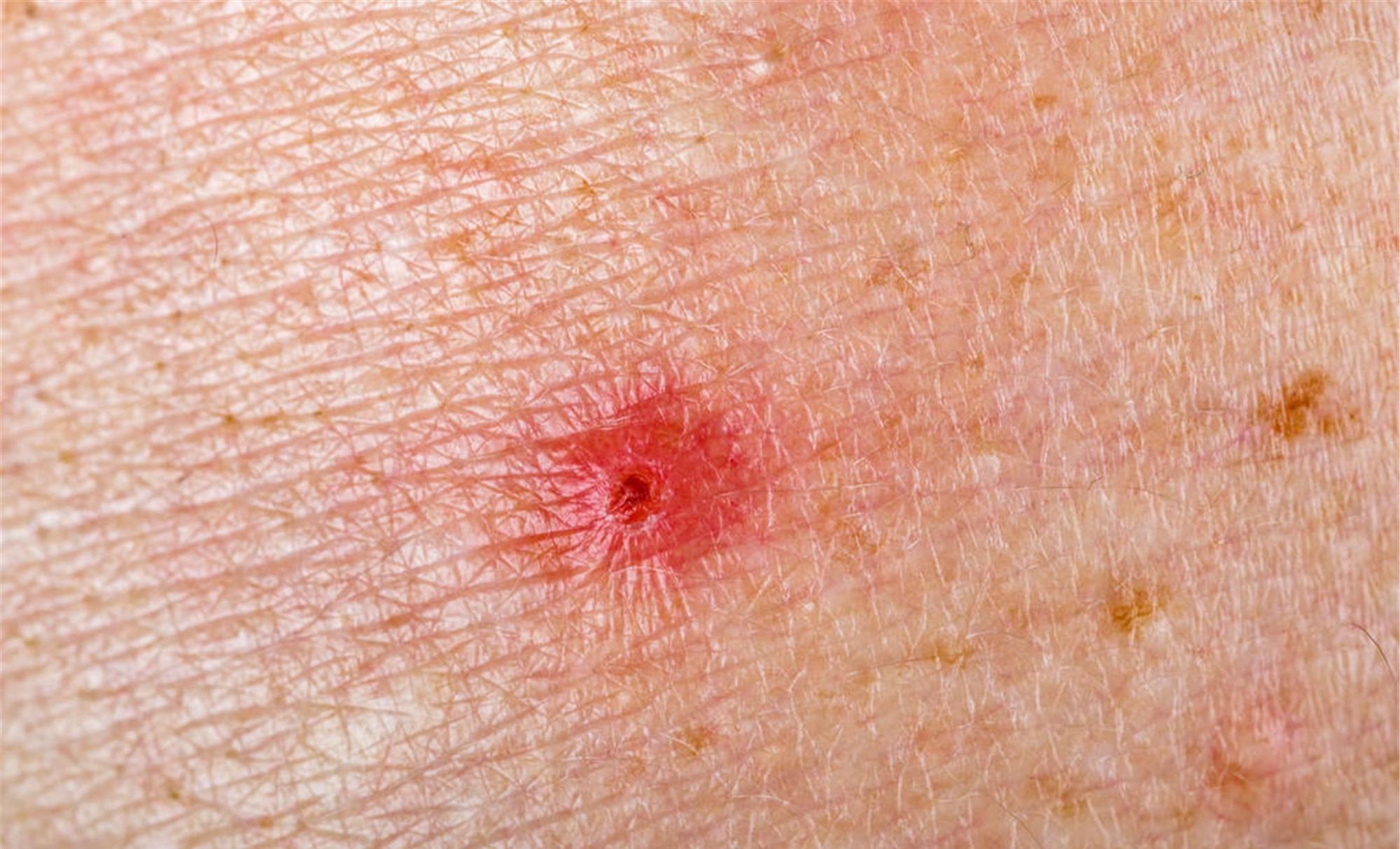 雷诺综合征需要及时明确诊断,并及早进行恰当的原发病治疗