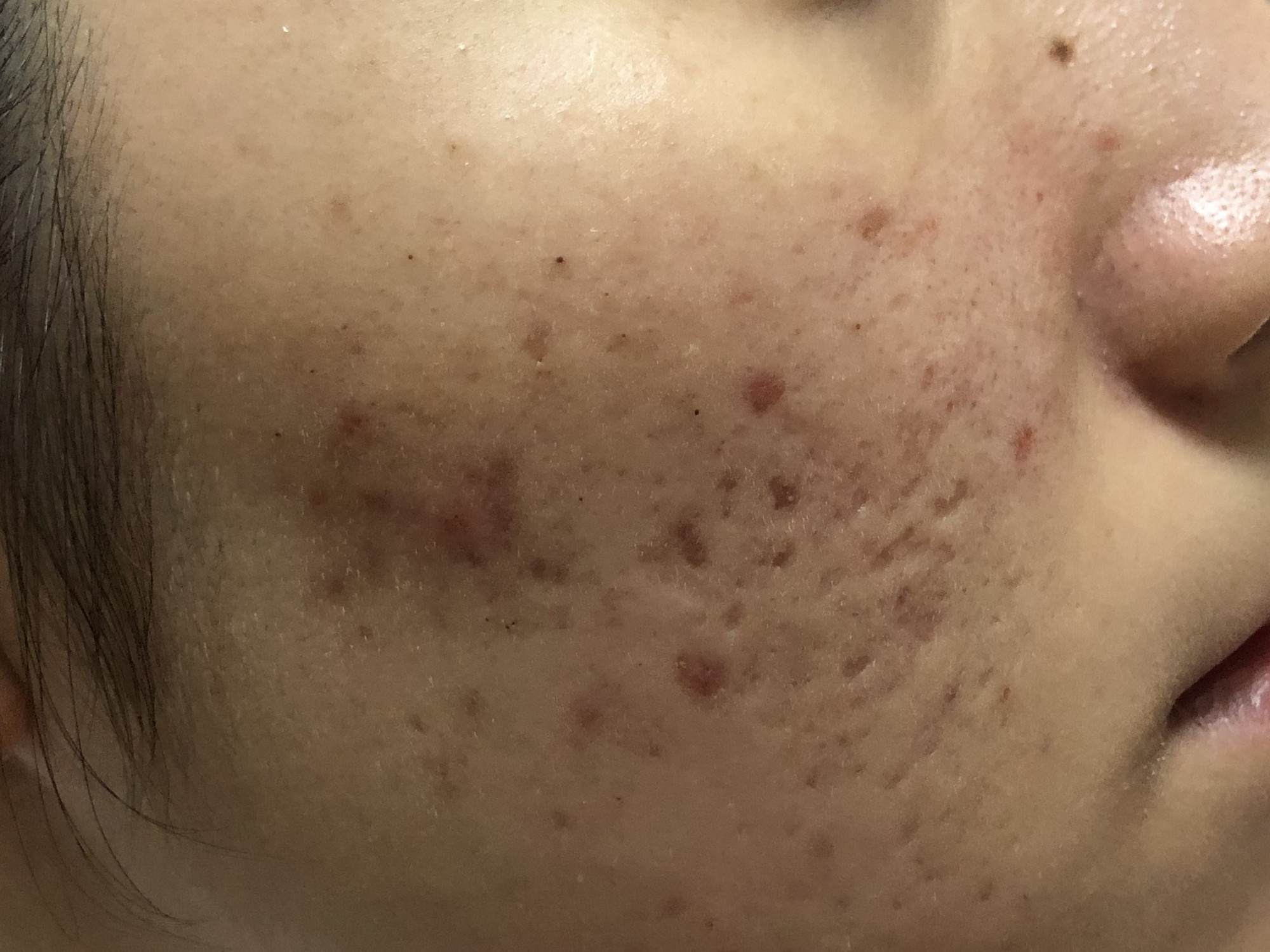 17岁女儿脸上长满痘痘,看了这篇文章才知道如何帮助她