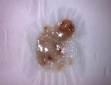 肺的"报警器"是痰?白痰,绿痰,黄痰,黑痰,分别代表了什么?